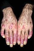 Psoriasis of the nails