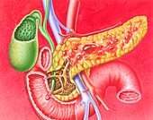 Pancreatitis,illustration