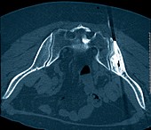 Secondary pelvic cancer being treated,CT