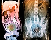 Post-operative bladder cancer,X-ray