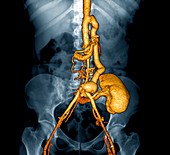 Takayasu's arteritis after treatment