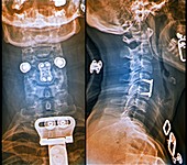 Herniated spinal disc after treatment