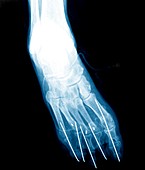 Bunion after surgery,X-ray