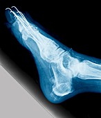 Bunion after surgery,X-ray