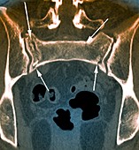 Fractured pelvis,CT scan