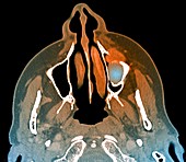 Giant cell granuloma of the jaw,CT scan