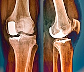 Partial knee replacement,X-ray