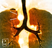 Aortic aneurysm,X-ray