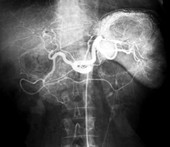 Spleen abscess,X-ray
