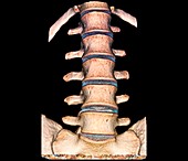 Normal spine,3D CT scan