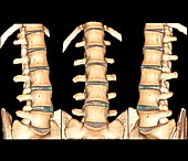 Normal spine,3D CT scans