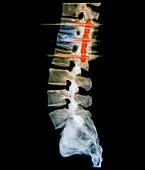 Pinned spinal fracture,X-ray