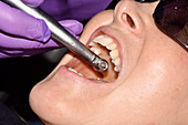 Dental filling