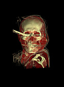 Knife skull injury,CT scan