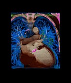 Coronary artery bypass graft,CT scan