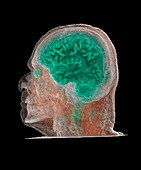 Human head and brain,CT scan