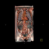 Aortic aneurysm stent,CT scan
