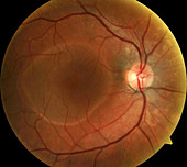 Retinal pigment epithelial detachment