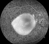 Retinal pigment epithelial detachment