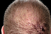 Folliculitis of the scalp