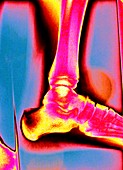 Ankle,coloured X-ray