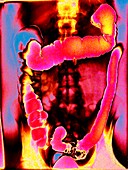 Colon,coloured abdominal X-ray