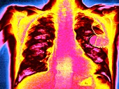 Defibrillator,coloured chest X-ray
