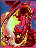 Foetus in uterus,MRI scan