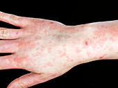 Epstein-Barr virus infection