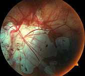 Marfan syndrome,fundus photograph