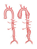 Aortic aneurysm,illustration