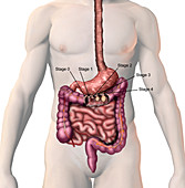 Colon Cancer,illustration