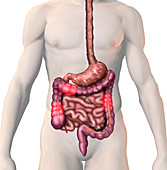 Irritable Bowel Syndrome,illustration