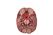 Transcortical apraxia,illustration