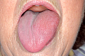 Swollen tongue