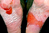 Foot blister in chemotherapy