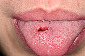 Tongue laceration