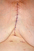 Coronary bypass graft wound