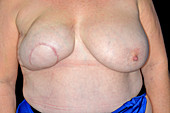 Breast reconstruction after cancer