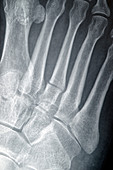 Broken toe,X-ray