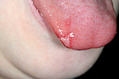 Hand foot and mouth disease