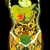 Liver cancer,X-ray