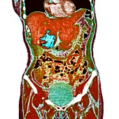 Liver cancer,X-ray