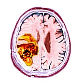 Brain cancer,MRI