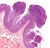 Large bowel polyps,light micrograph