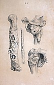 Diseased bones,18th century