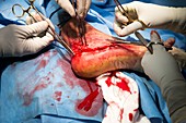 Heel bone surgery