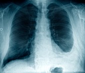 Pleural effusion,X-ray