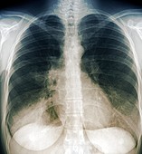 Chest infection,X-ray
