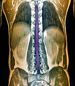 Normal spinal cord,MRI